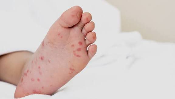 В Київській області зафіксований спалах хвороби Коксакі – захворіли 13 дітей, 12 із них уже завершили стаціонарне лікування